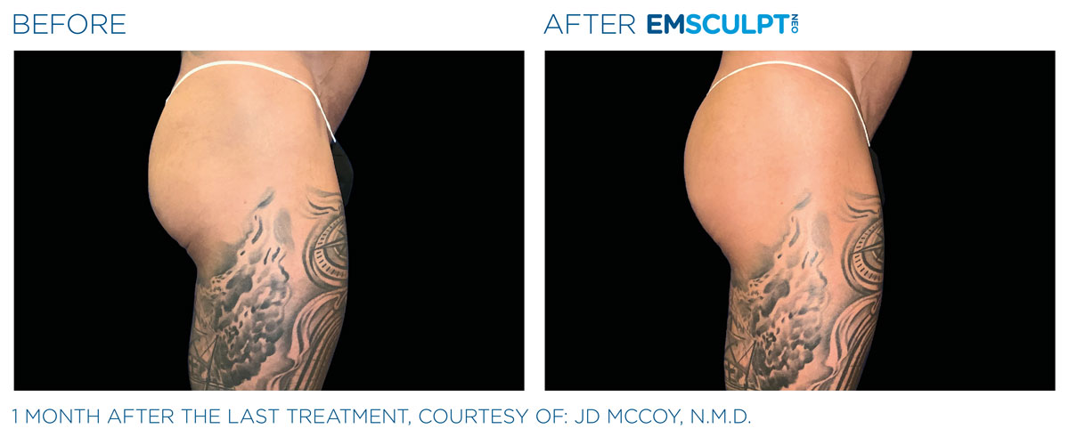Before and after results of EmSculpt NEO