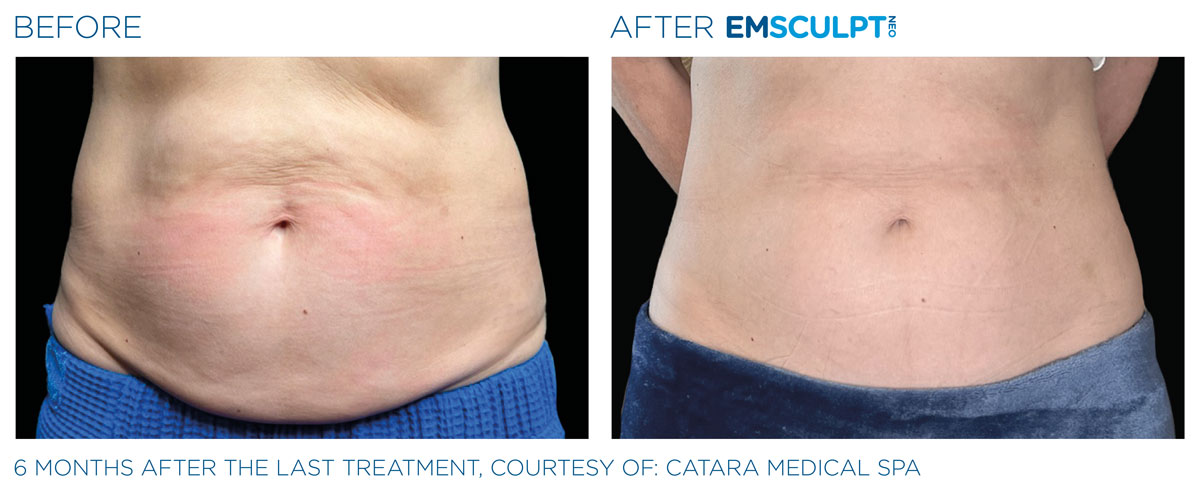 Before and after results of EmSculpt NEO