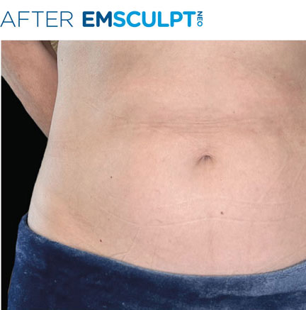 Before and after results of EmSculpt NEO