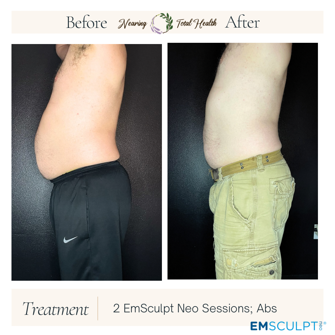 Copy of Copy of Neutral Before and After Instagram Post Before and After of the EmSculpt NEO